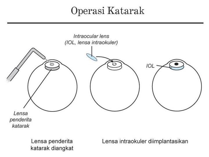 Katarak